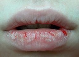 Cracked corners of mouth: How to treat them?