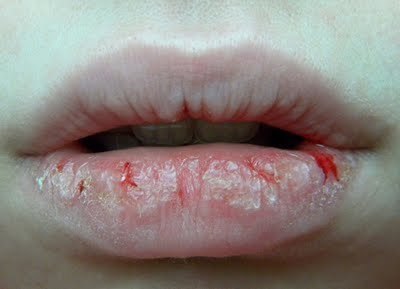 Напукани ъгълчета на устните: Как да ги лекуваме?