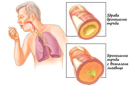 Bronchitis