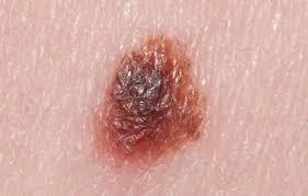 Plain vegetable treat skin cancer